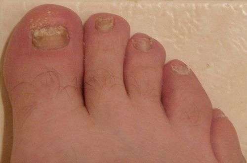 Discover How to Get Rid of Toenail Fungus Fast