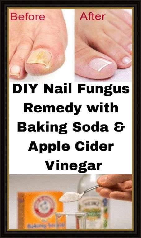 DIY Nail Fungus Remedy with Baking Soda &  Apple Cider ...