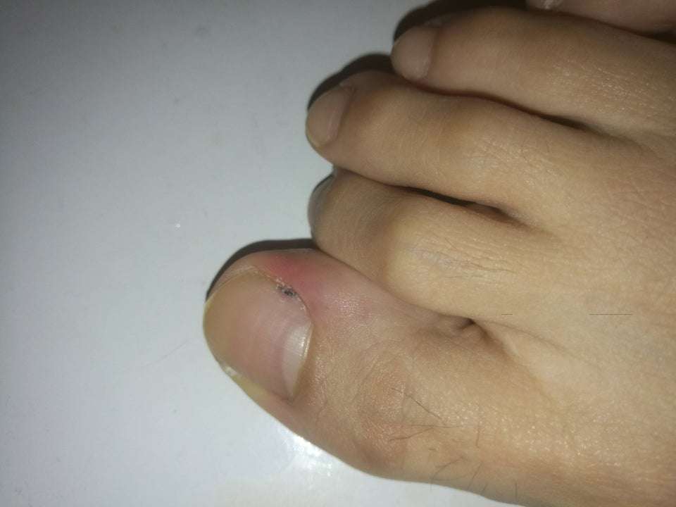 Does the short black line on my toe look like cancer ...