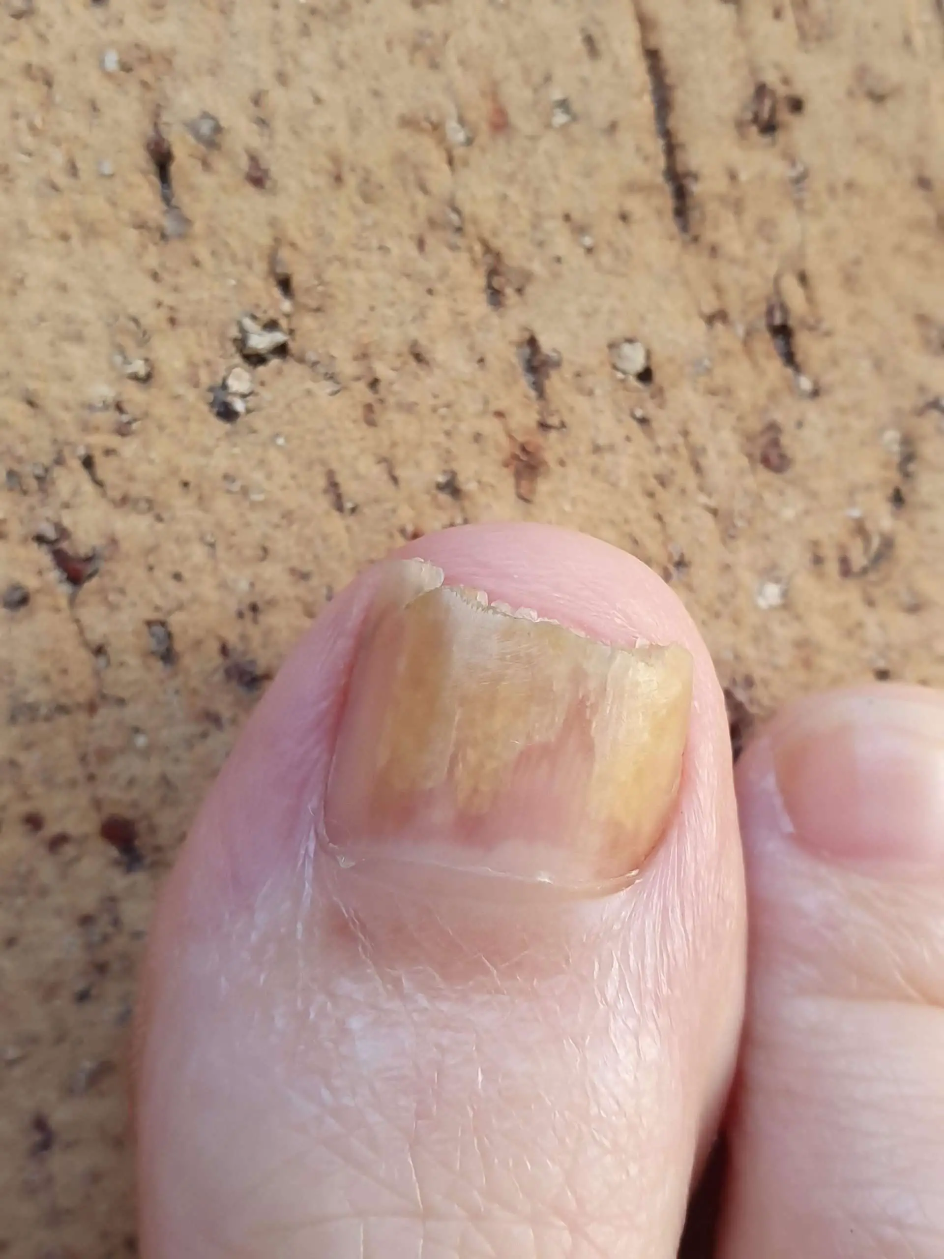 Does this look like nail fungus? I remember kicking the ...
