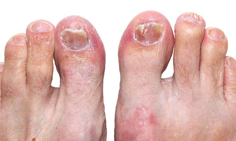 Does Toenail Fungus Ever go Away on Its Own?: Jeremy Moran ...