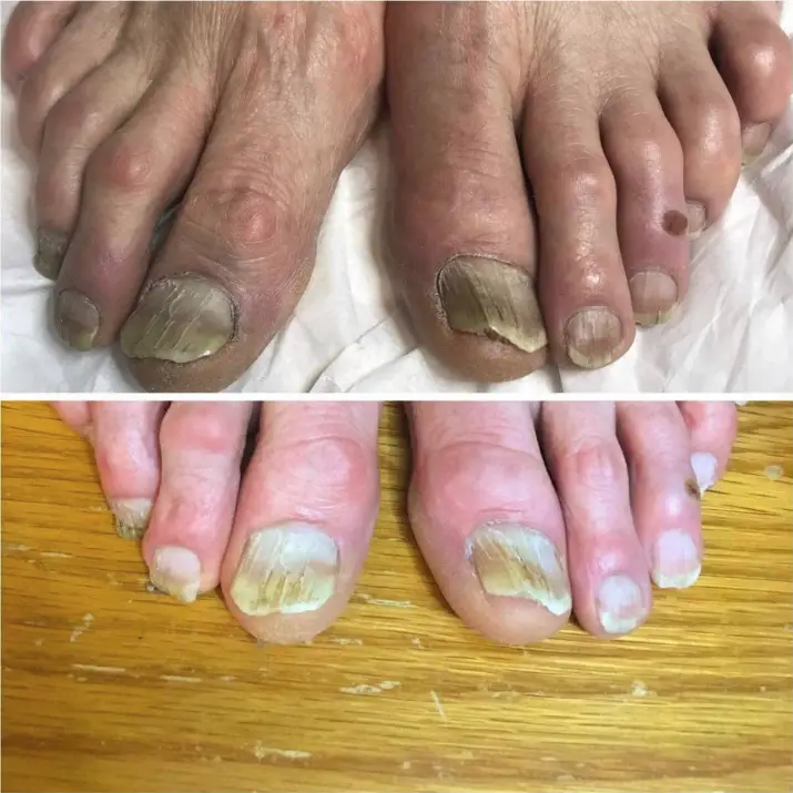 Effective &  Efficient Nail Fungus Removal