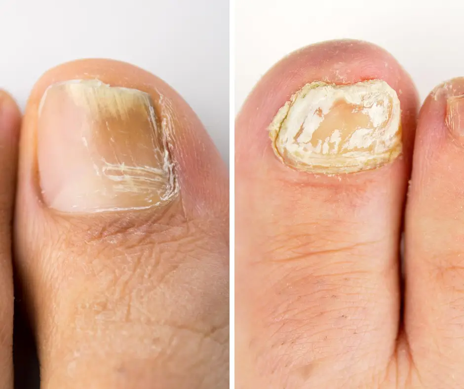 Embarrassing foot problems: Fungal nails
