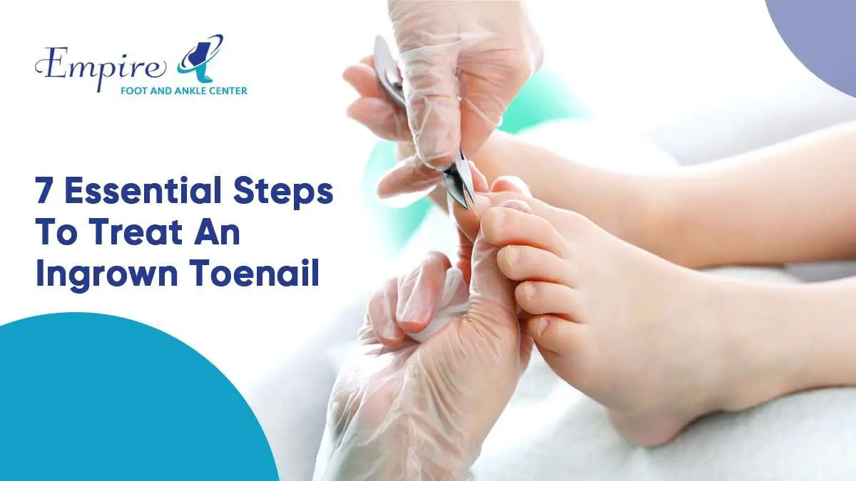 Essential Steps To Treat An Ingrown Toenail