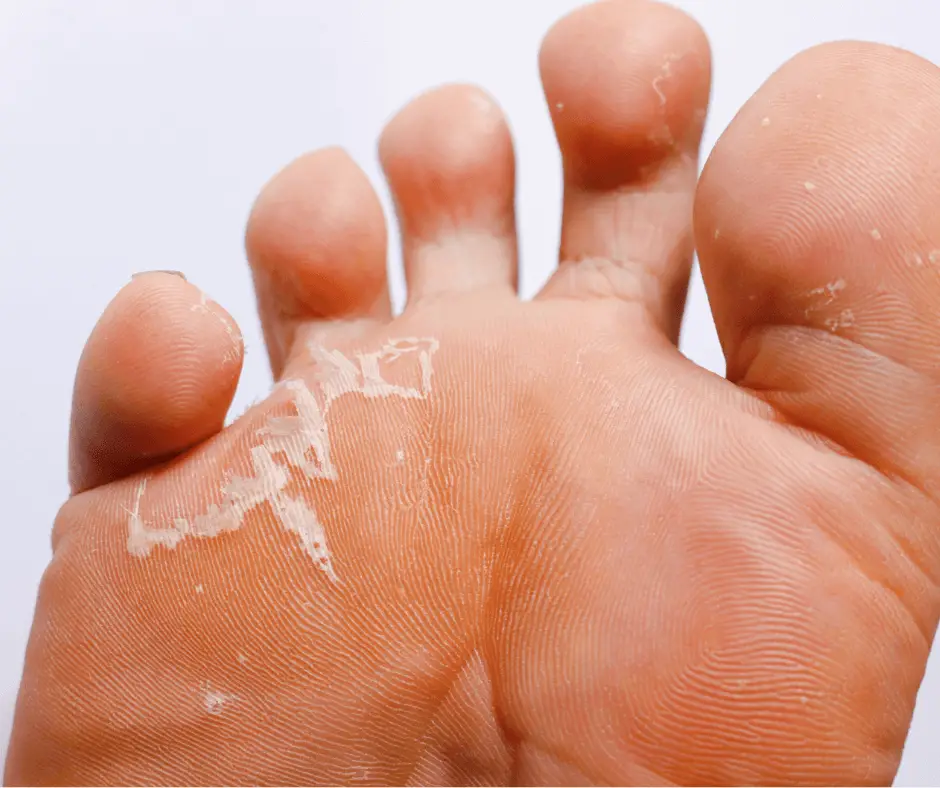 Expert Treatment for Toenail Fungus in North Seattle