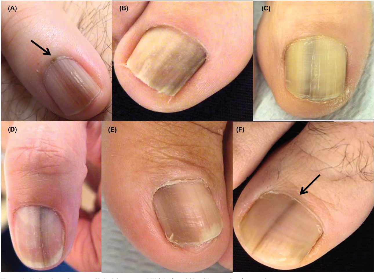 Figure 5 from Nail melanoma in situ: clinical, dermoscopic ...