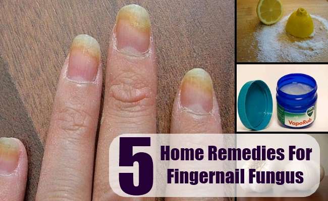 Fingernail Fungus Home Remedy