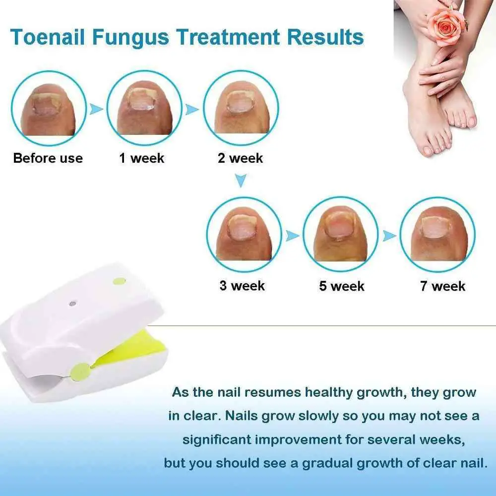 Fingernails Toenails Toe Nail Fungus Cold Laser Therapy Onychomycosis ...