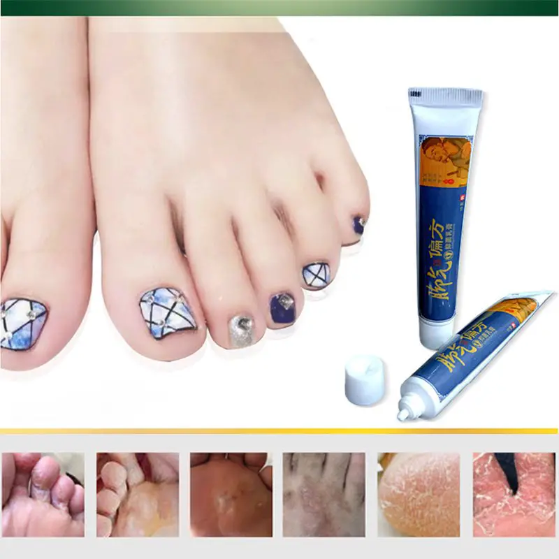 Foot Cream Remove Fungus Removal Relieve Itching Moisturizing Skin ...
