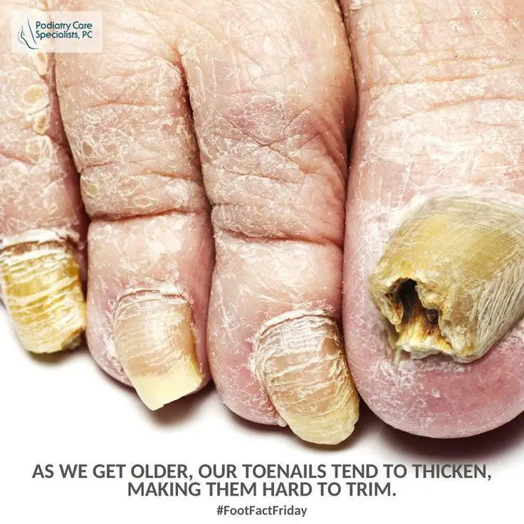#FootFactFriday: As we get older, our toenails tend to thicken, making ...