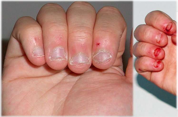 Four (4) Reasons To Stop Biting Your Nails