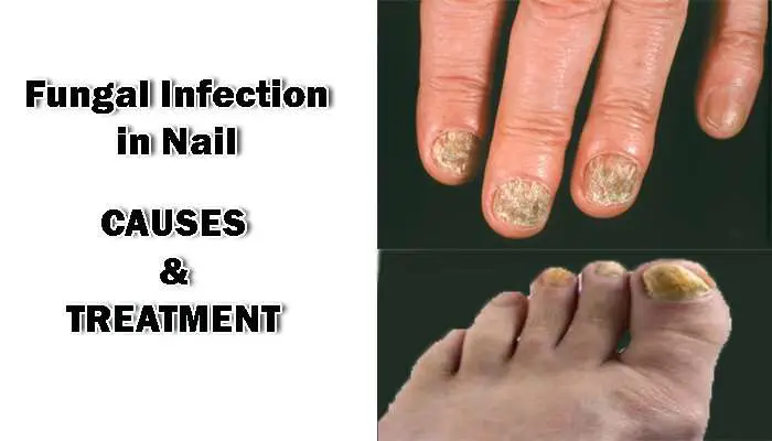 Fungal infection in nails : Causes, Tips and Treatment ...