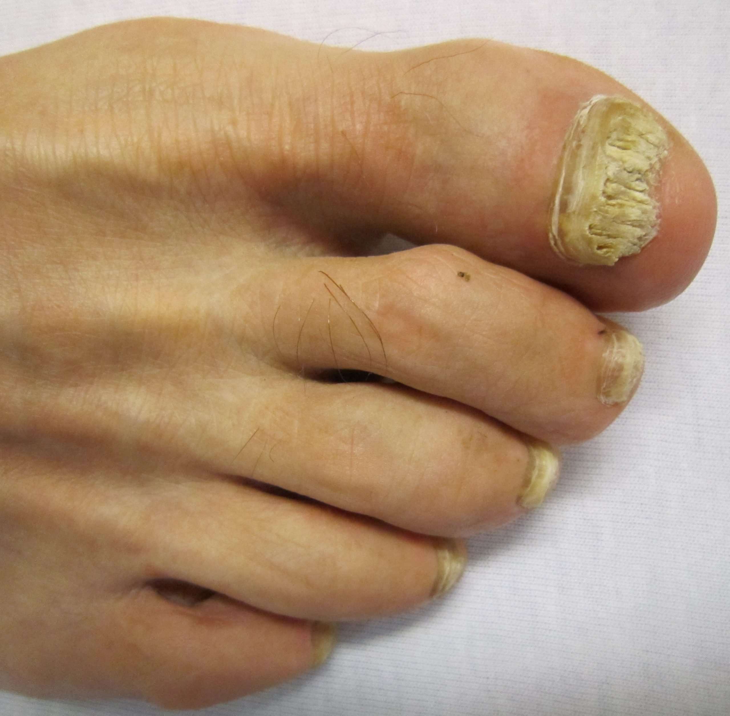Fungal nail infection. Causes, symptoms, treatment Fungal ...