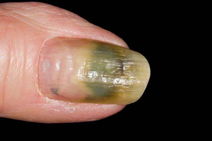 Fungal Nail Infection Of The Thumb Photograph by Dr P ...