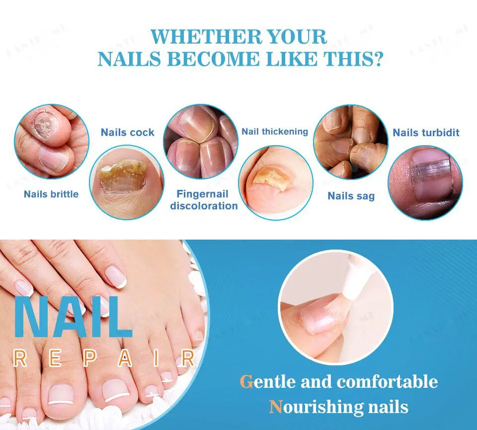 Fungal Nail Treatment Pen Anti Fungal Nail Infection Gel Foot Toe Nail ...