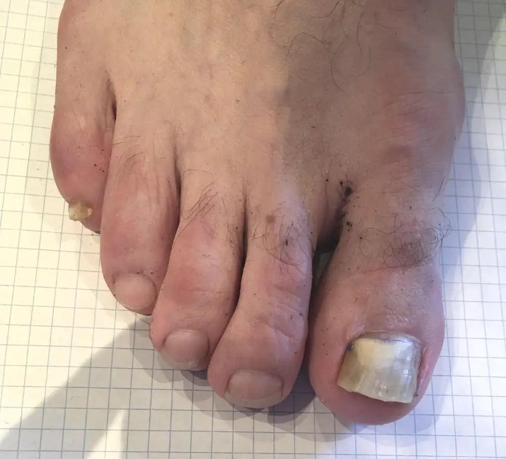 Fungal toenail treatment in Australia
