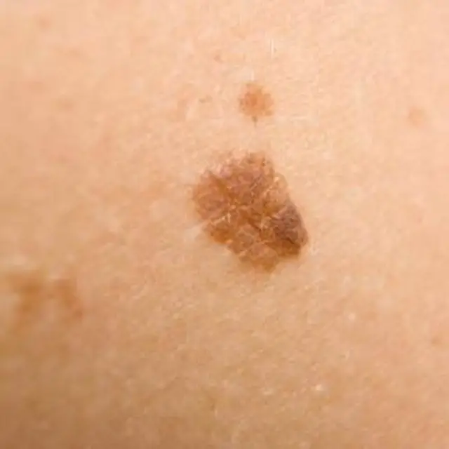 Fungus Brown Spots On Skin Pictures