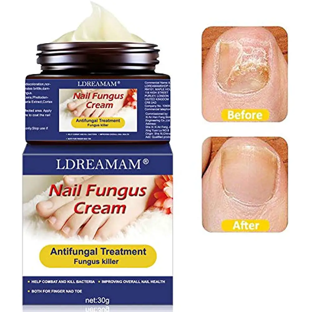Fungus Treatment Cream, Nail Foot Fungus, Stop, Anti Fungal Nail ...