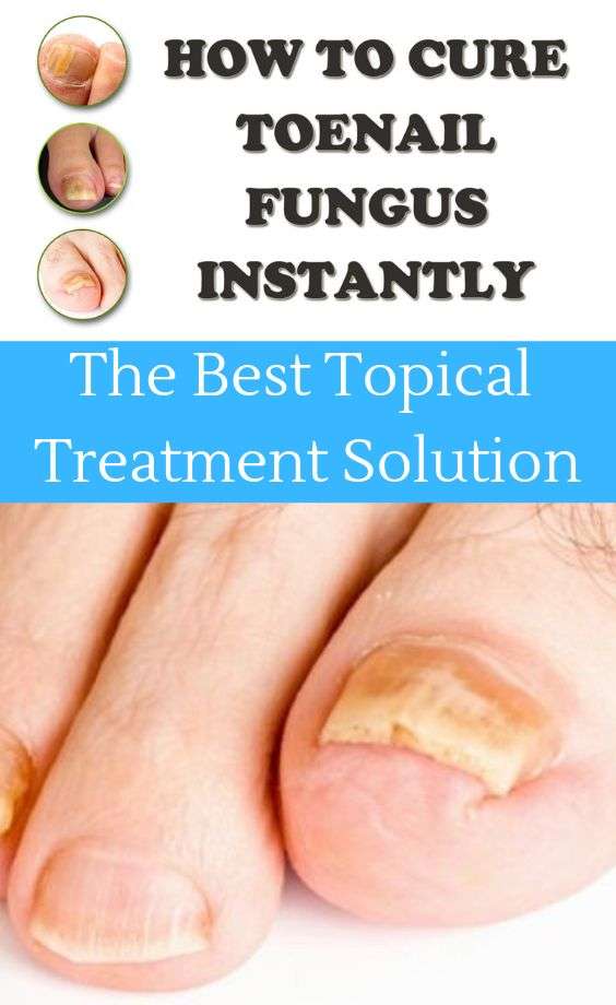 Get Rid Of Fungus Toenails. Fungal nail infection is ...