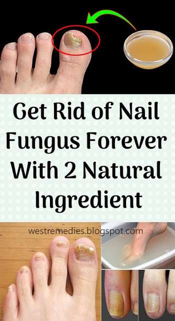 Get Rid of Nail Fungus Forever â 2 Ingredient Recipe ...