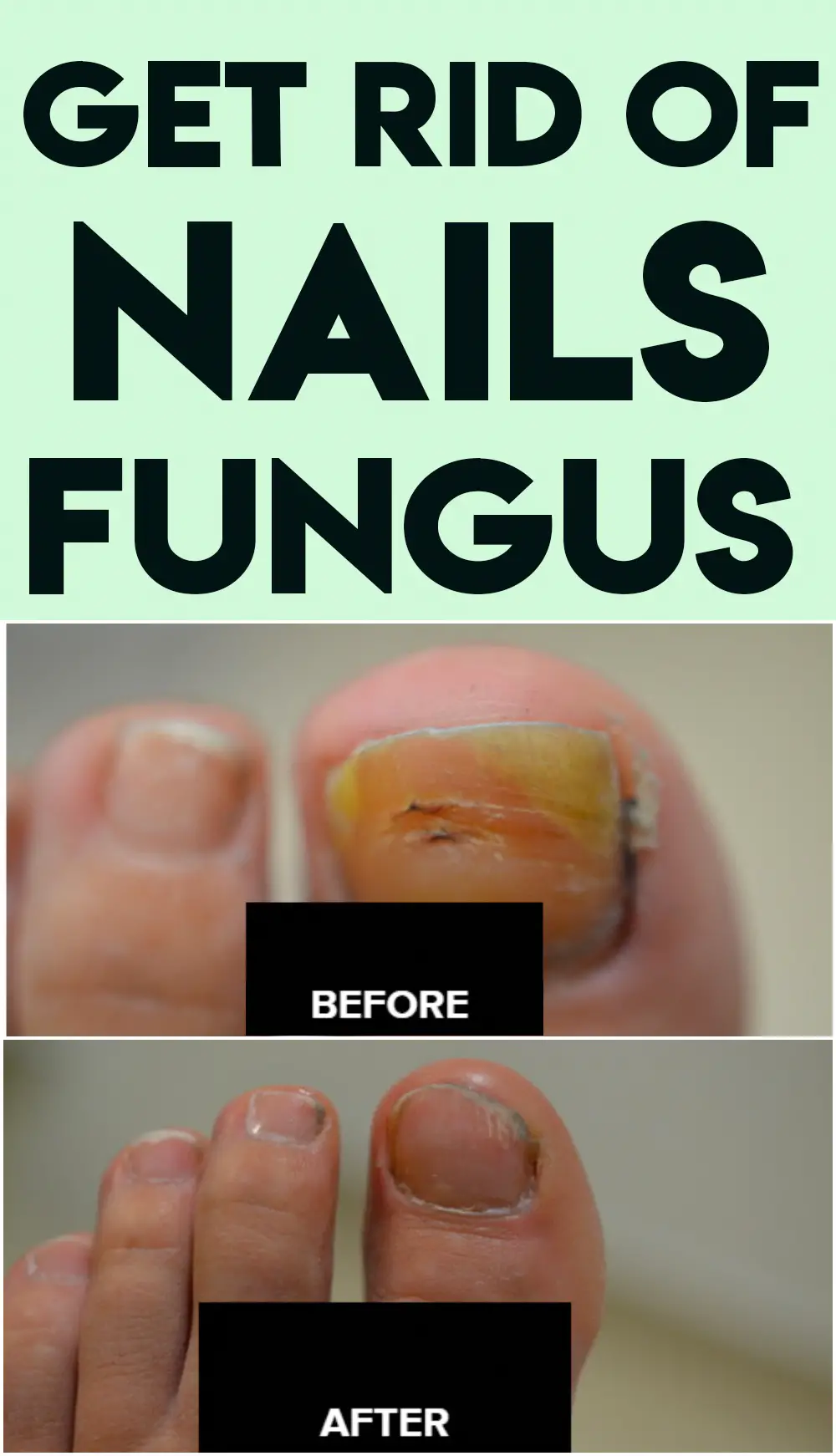 Get Rid Of Nails Fungus in 2020