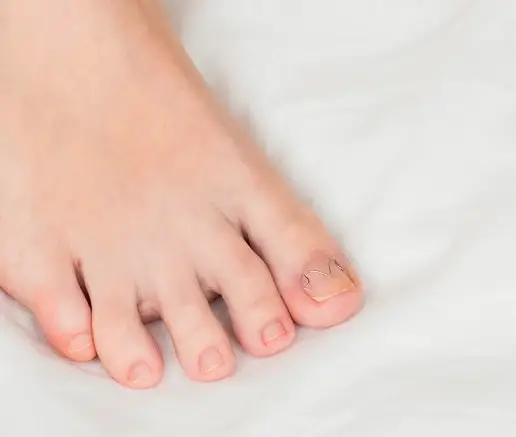 Growing Your Toenail Back After Getting Nail Fungus  My Clean Nails