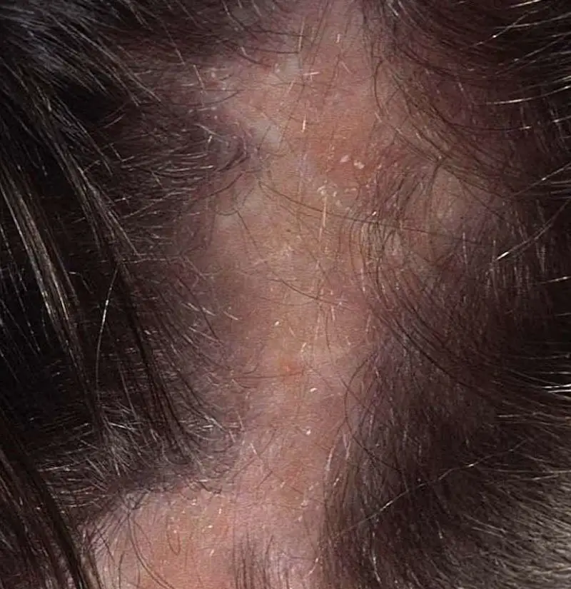 Hair Loss Yeast Infection
