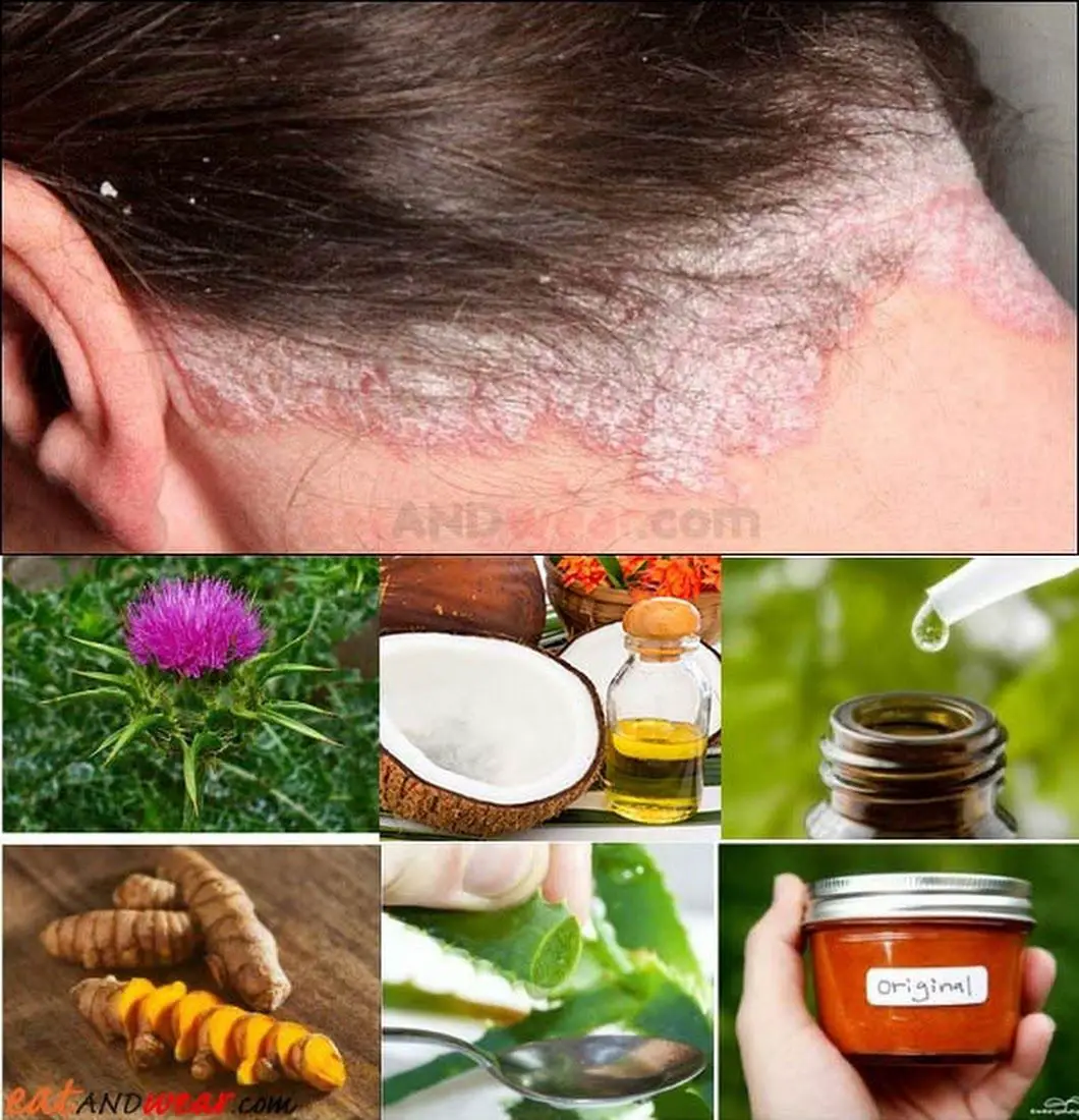 Hair Scalp Psoriasis: Natural Remedies &  Medical Treatments # ...