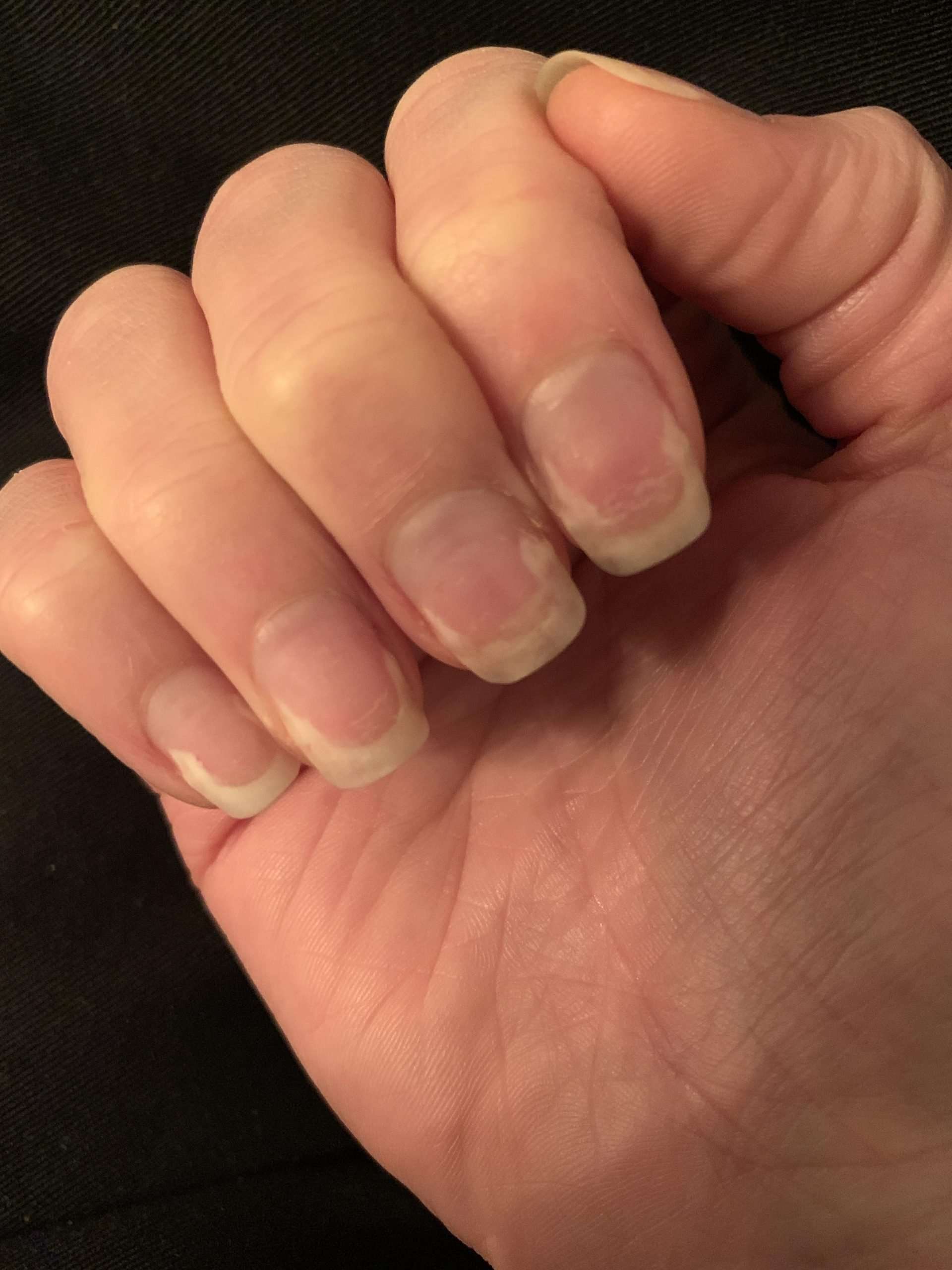 Has anyone else experienced nails like this after getting ...
