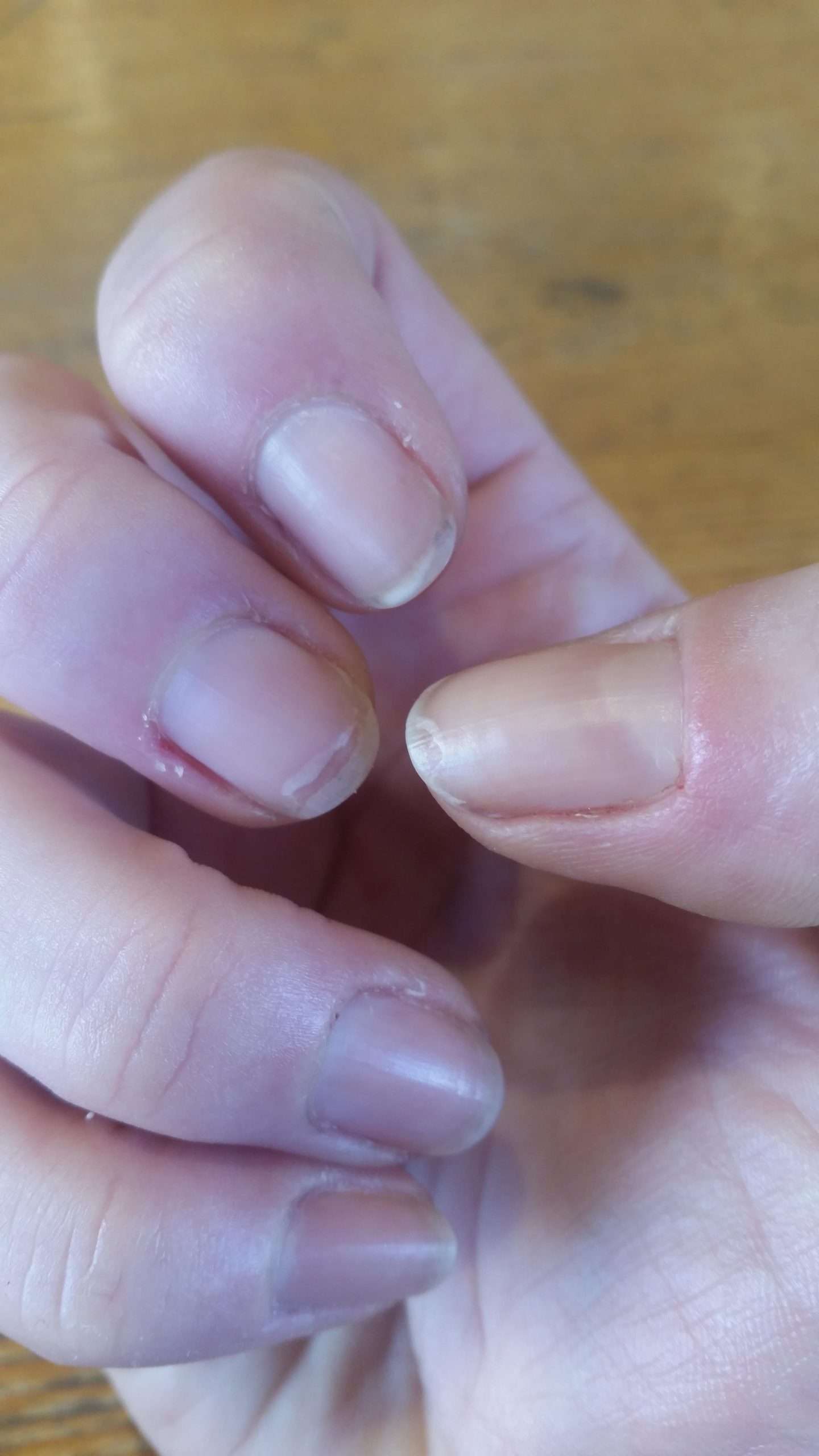 Help. Suggestions needed on how to better care for my nails to stop ...