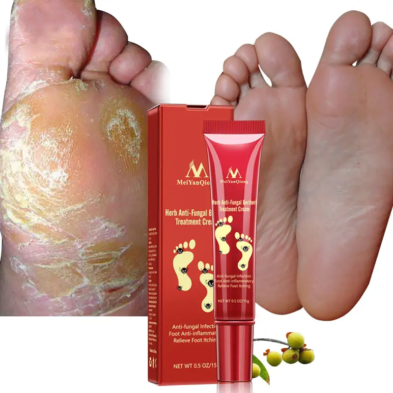 Herbal Foot Treatment Anti Fungal Infection Onychomycosis Paronychia ...