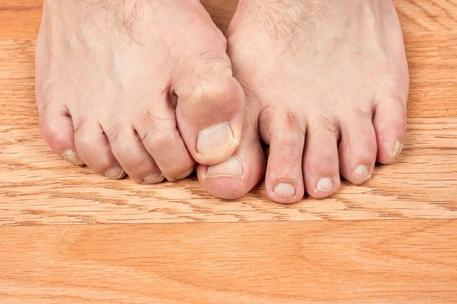 How do I know if I have a fungal infection in my toenails ...