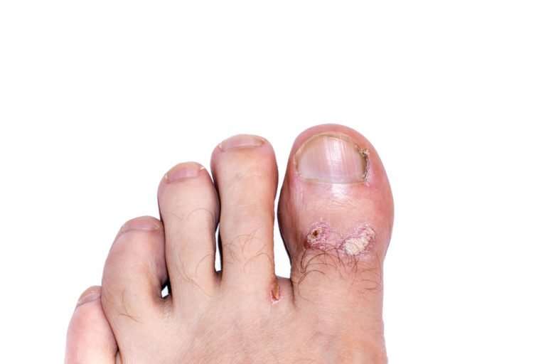 How Do I Know Whether I Have Nail Fungus or Nail Psoriasis ...