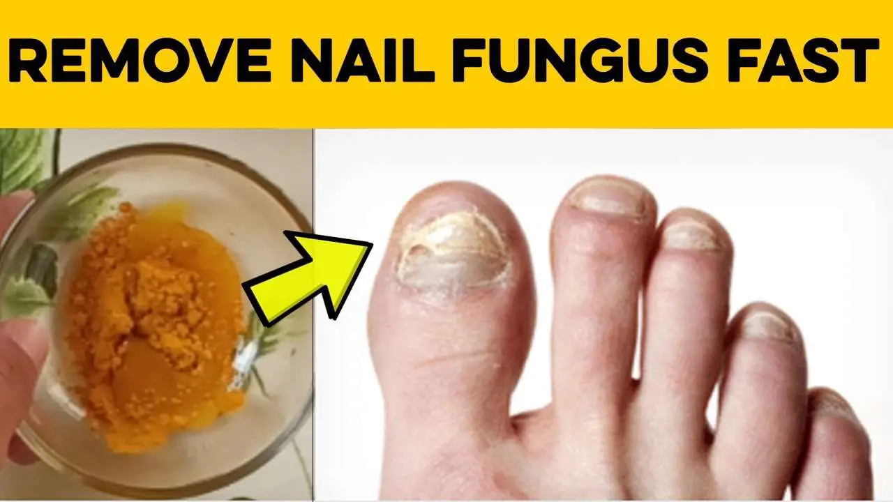 How to Cure Nail Fungus â 2 Home Remedies for Toenail ...