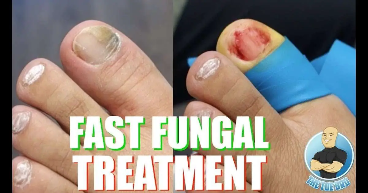 How To Cure Nail Fungus Quickly