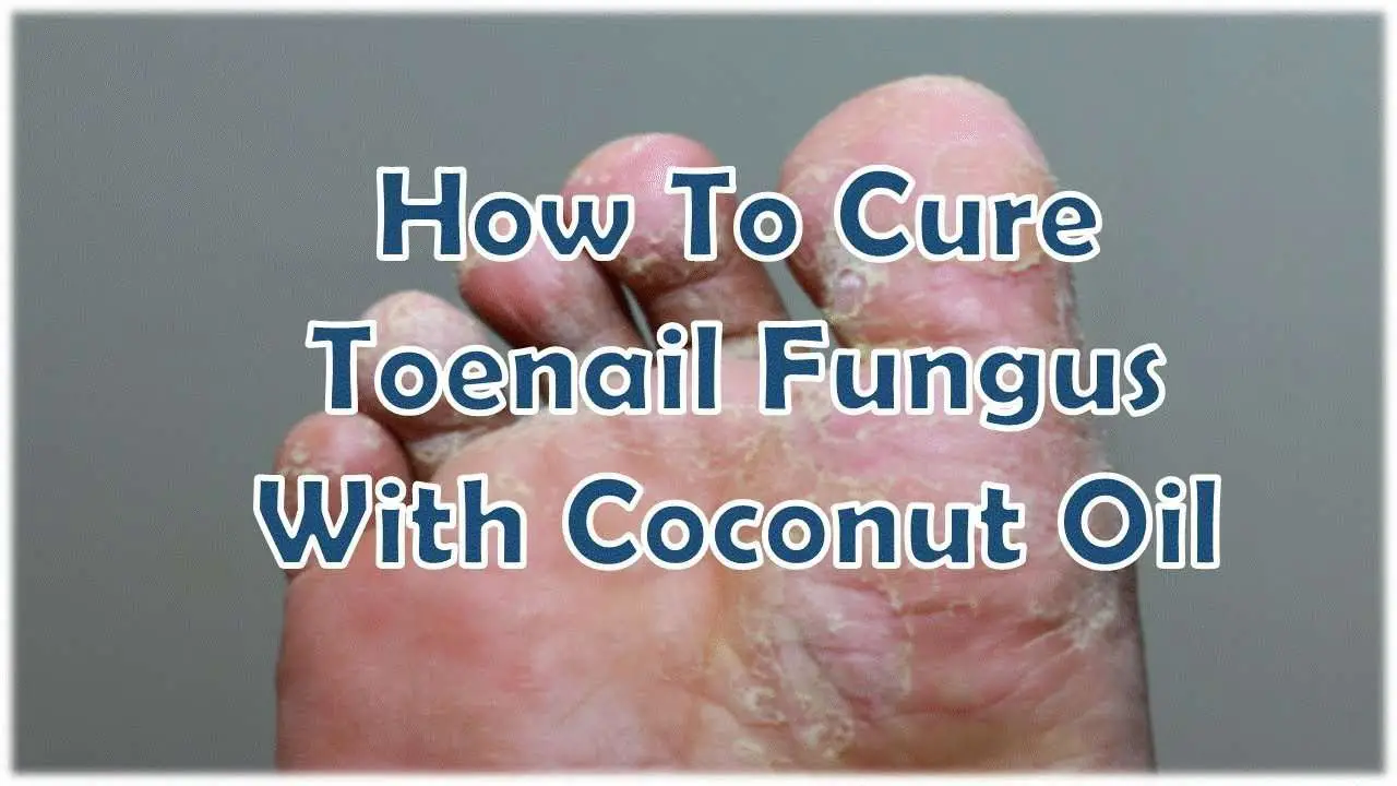 How To Cure Toenail Fungus With Coconut Oil