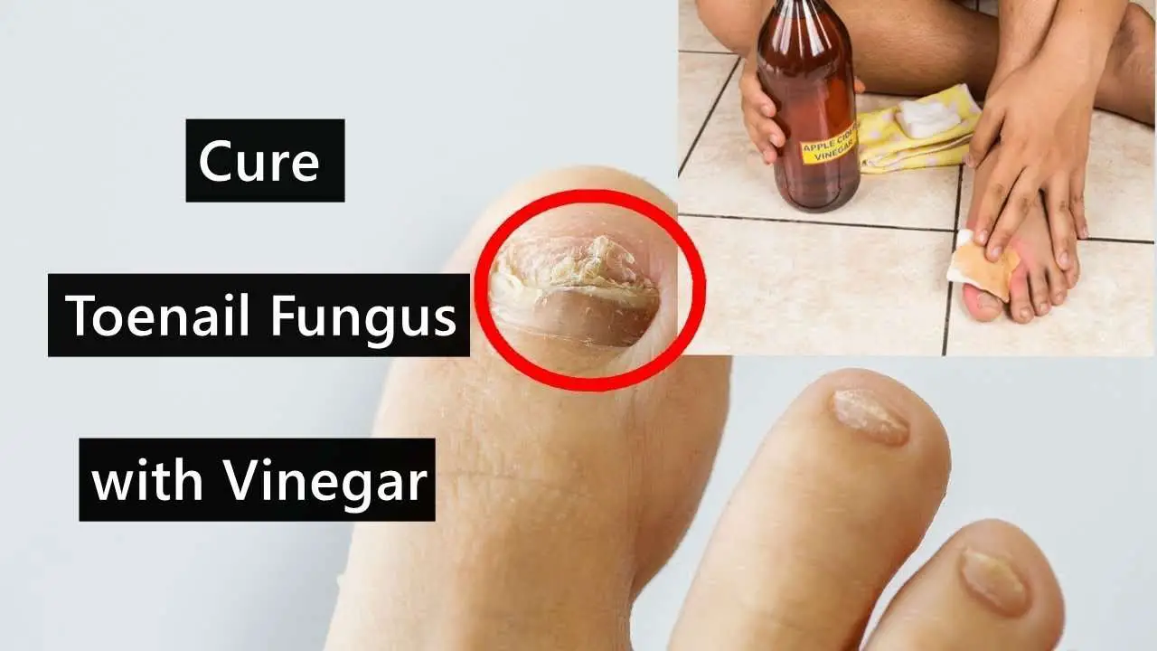 How to Cure Toenail Fungus with Vinegar