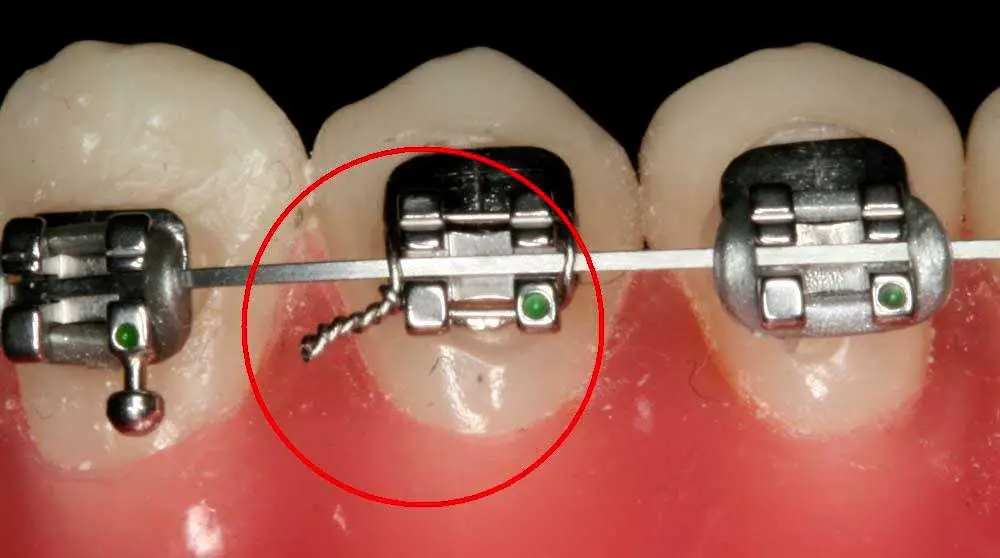 How To Cut Braces Wire With Nail Clipper