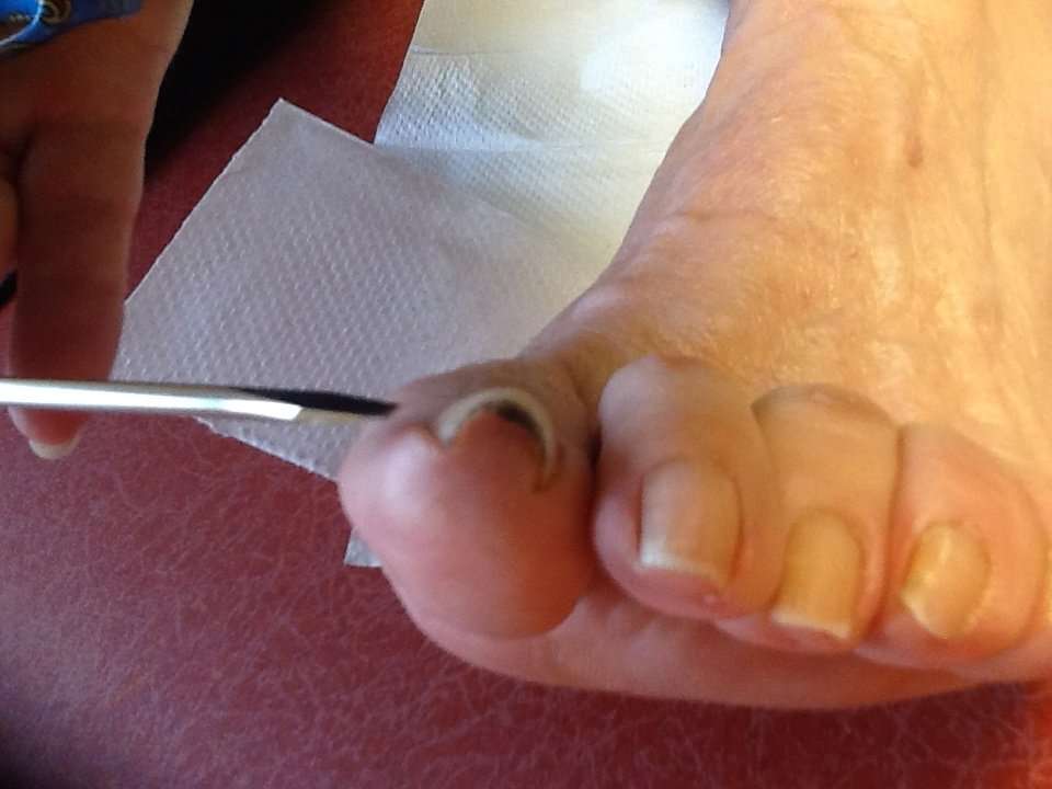 How to fix a curved toenail