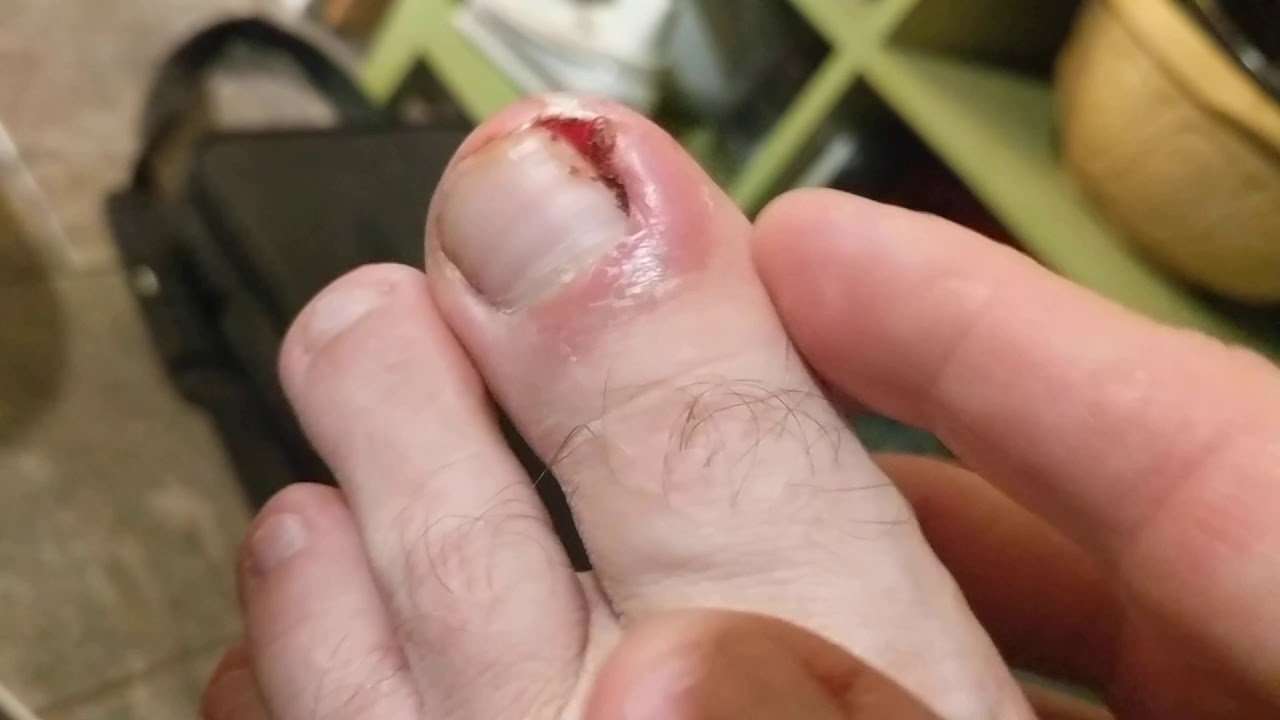 How to fix an ingrown toenail