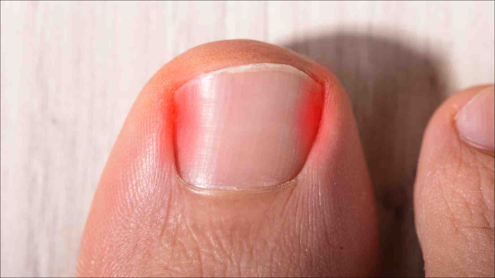How to Fix (and Prevent) an Ingrown Toenail â LifeSavvy