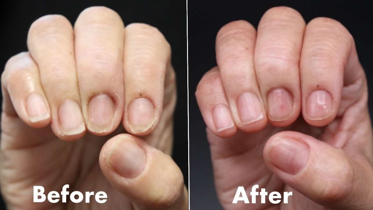 How To Fix DAMAGED, THIN &  BRITTLE NAILS!!! ***NATURAL ...