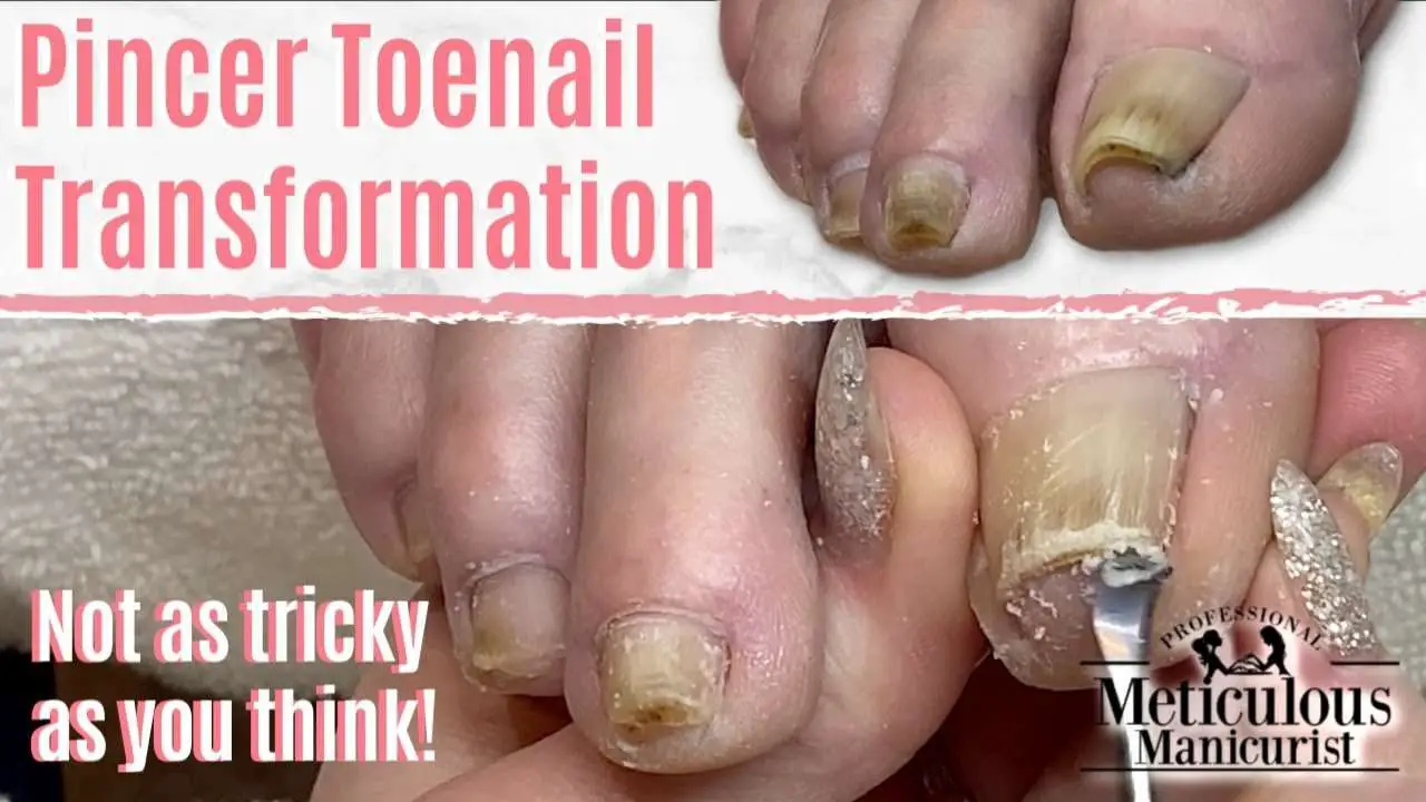  How to Fix Ingrown Toenail Pincer Nails Caused Nail ...