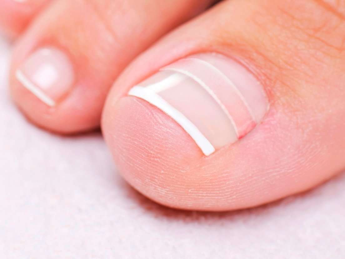 How To Fix Pincer Nails