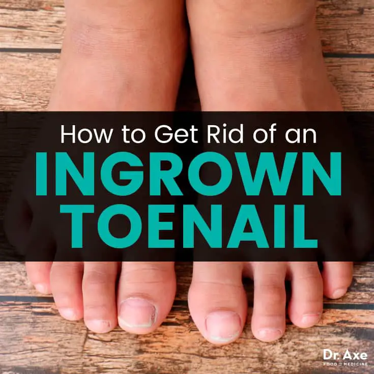 How to Get Rid of an Ingrown Toenail: Removal and Remedies ...