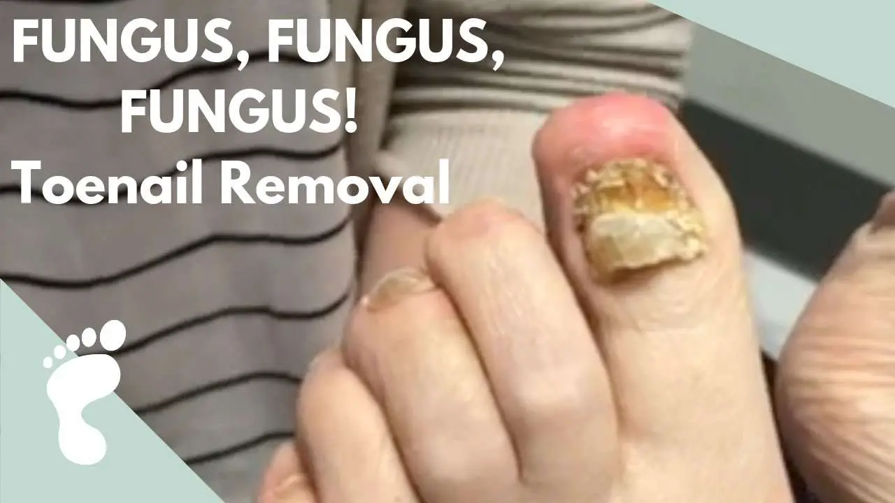 How To Get Rid Of Fungus On Nail Bed
