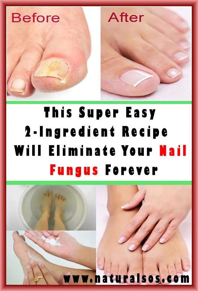 How To Get Rid Of Mold Under Nails