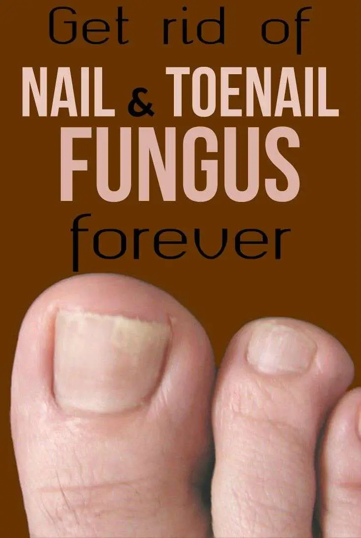 How to get rid of nail and toenail fungal infection without chemicals ...