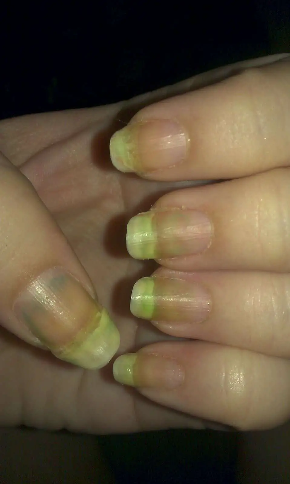 How to Get Rid of Nail Discoloration