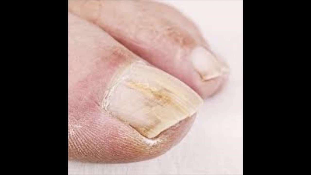 How To Get Rid Of Nail Fungus From Artificial Nails